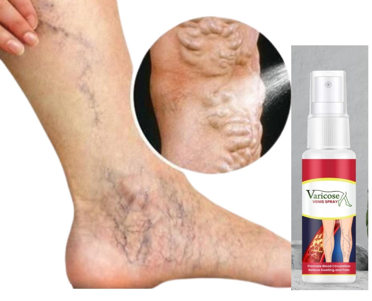 Varcose Venis Spray (Pack of 2)