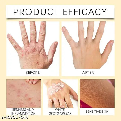Vitiligo Bee Venom Treatment Cream (Pack of 1)